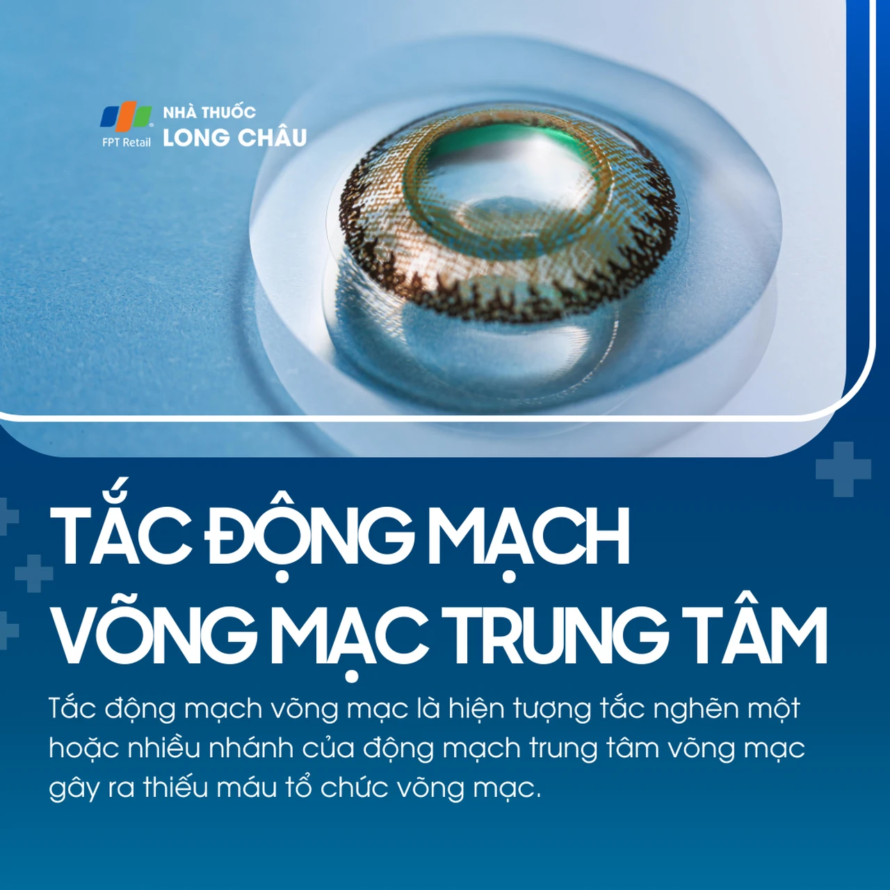 Tắc động mạch võng mạc trung tâm 1