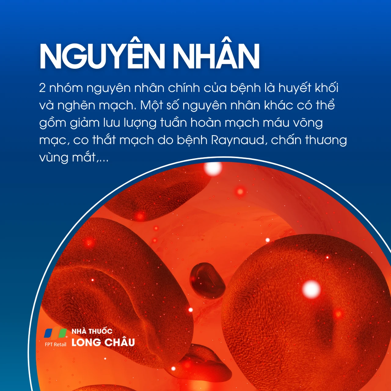 Tắc động mạch võng mạc trung tâm 3