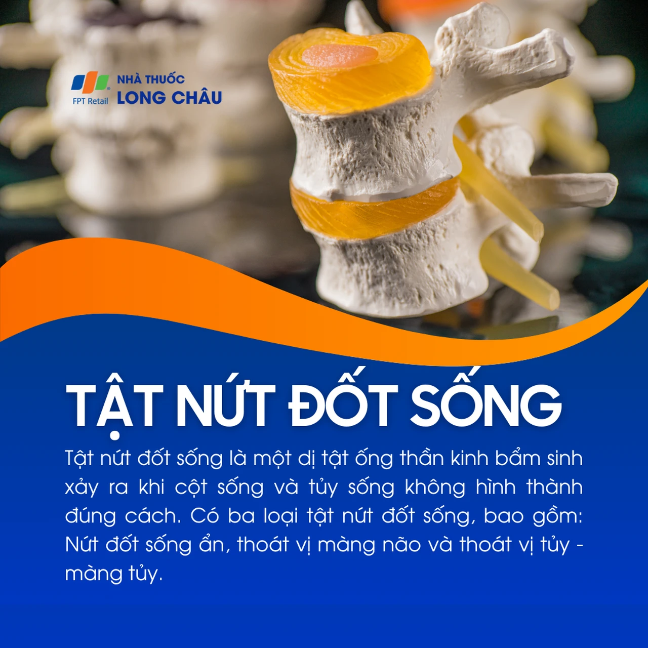 Tật nứt đốt sống 1