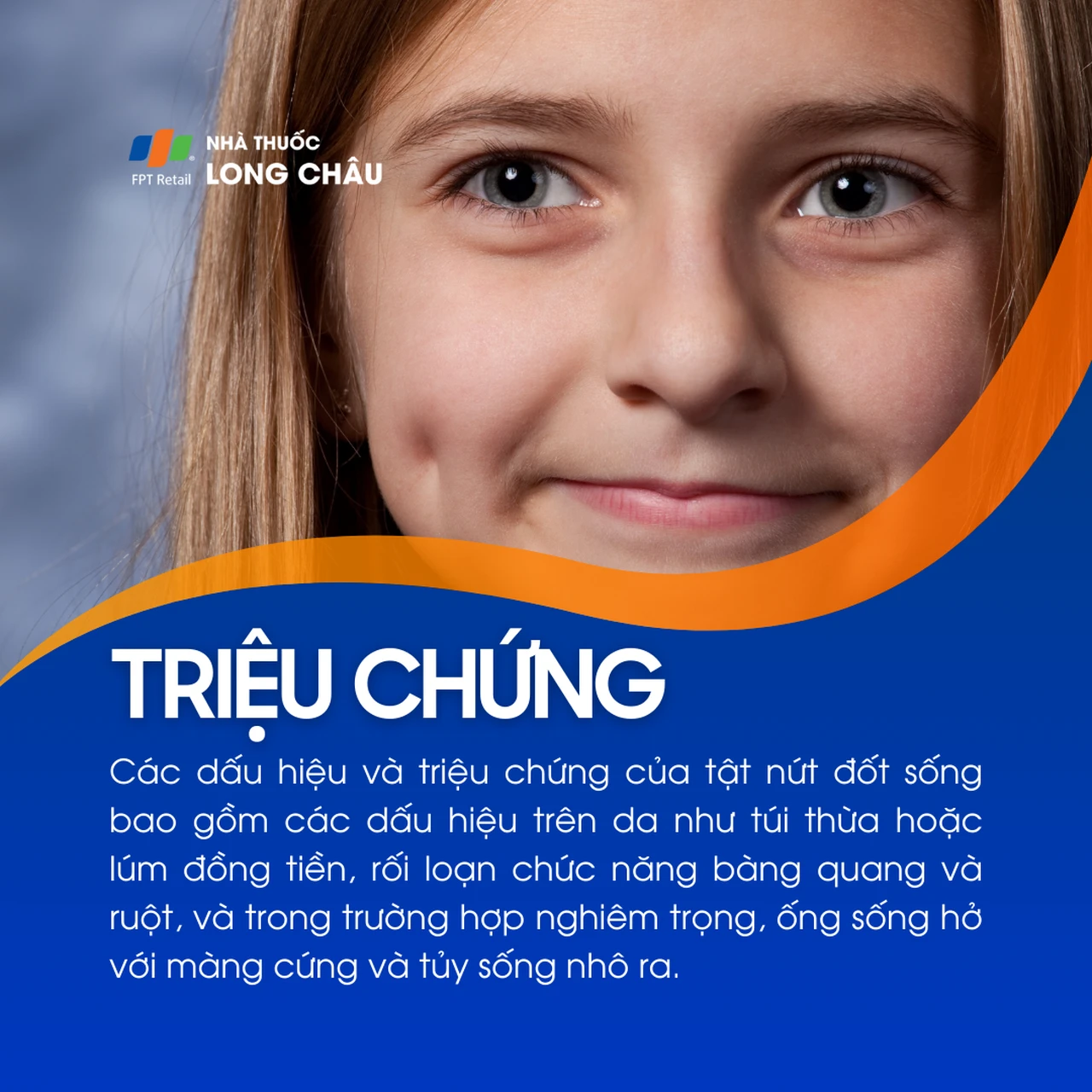 Tật nứt đốt sống 2