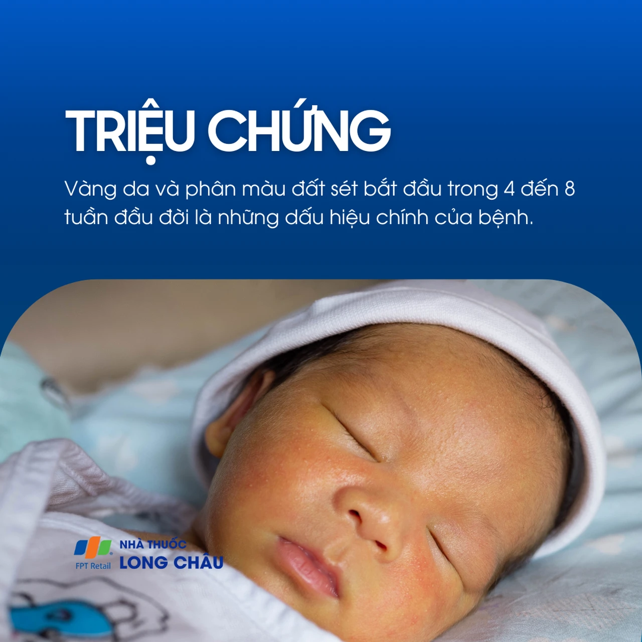 Teo đường mật bẩm sinh 2