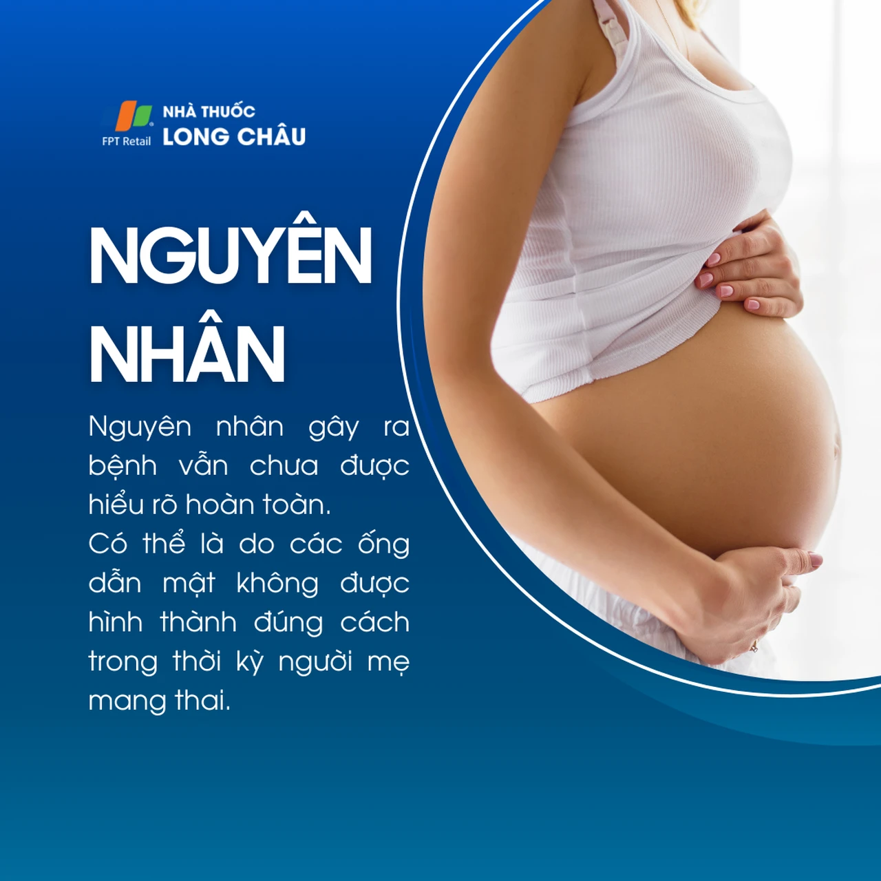 Teo đường mật bẩm sinh 3