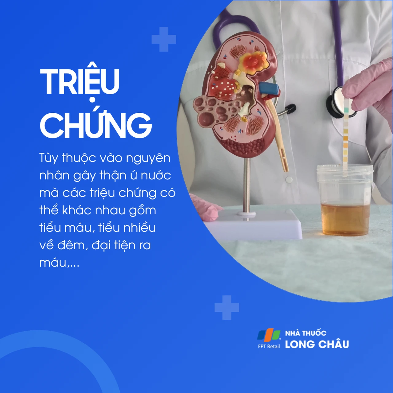 Thận ứ nước 2