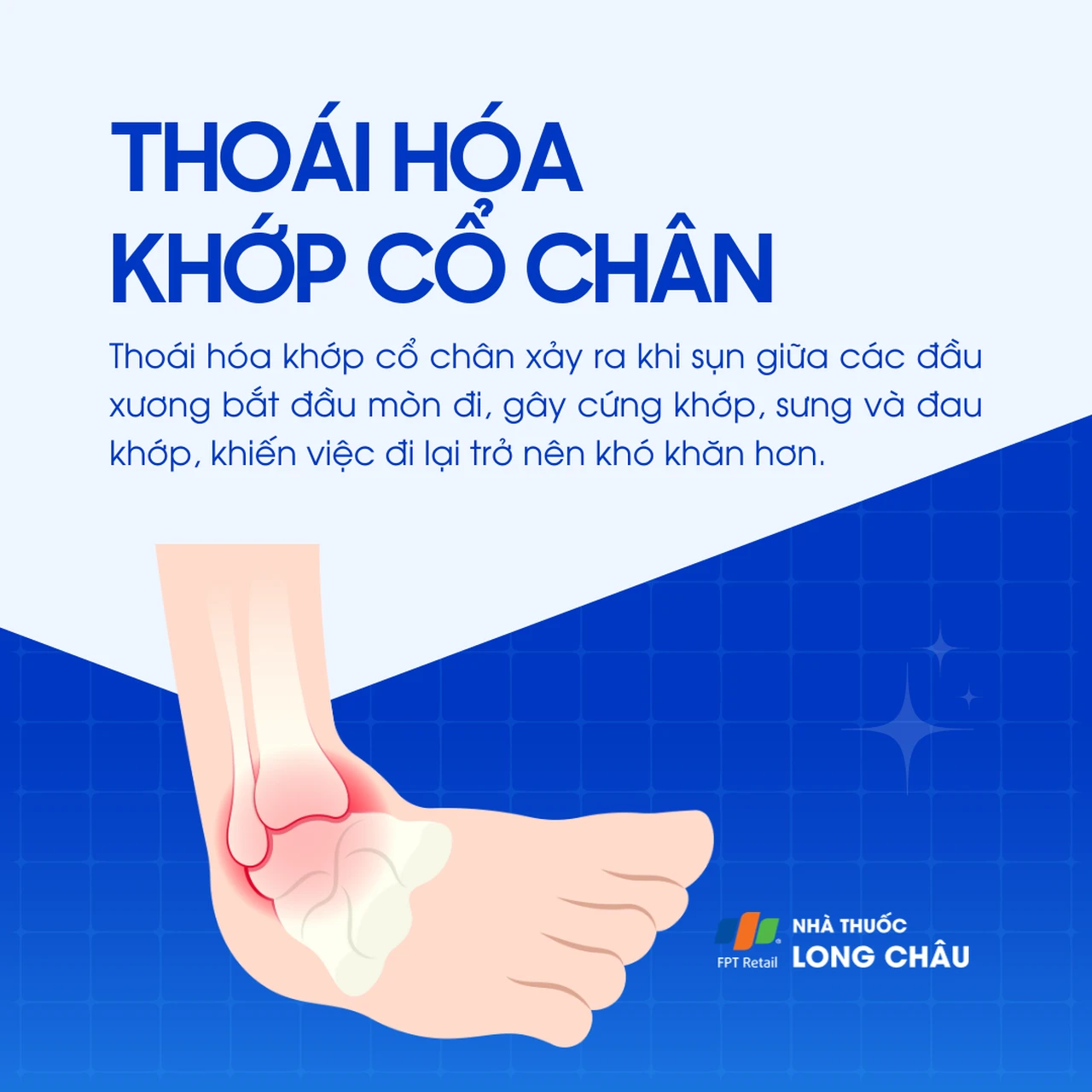 Thoái hóa khớp cổ chân 1