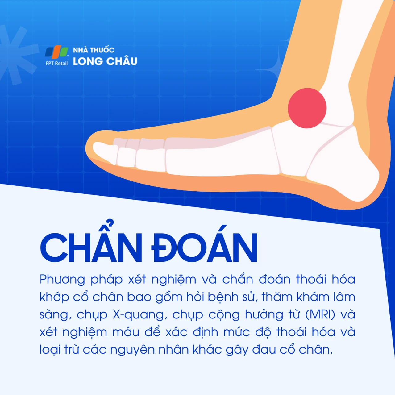 Thoái hóa khớp cổ chân 5