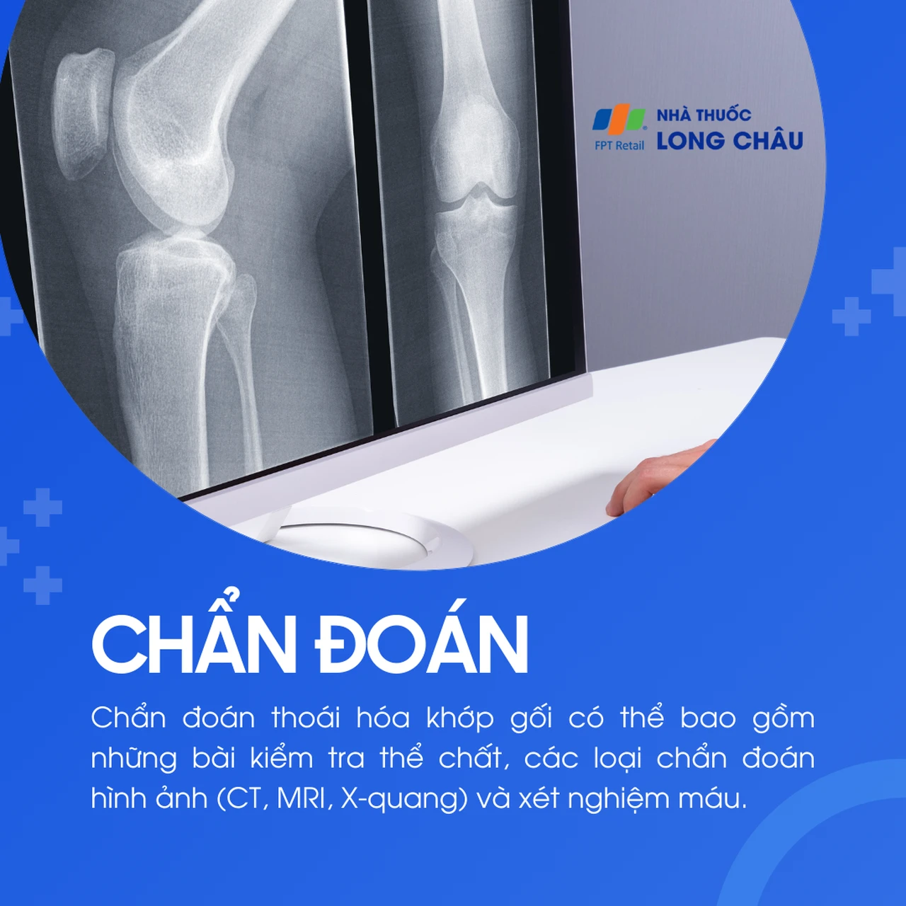 Thoái hóa khớp gối 5