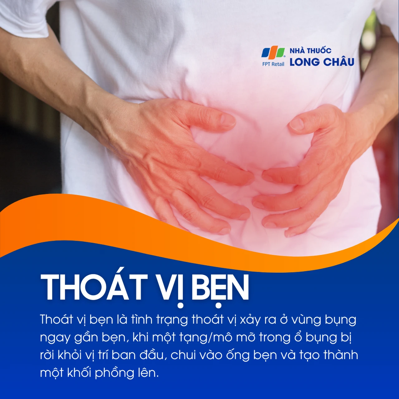 Thoát vị bẹn 1