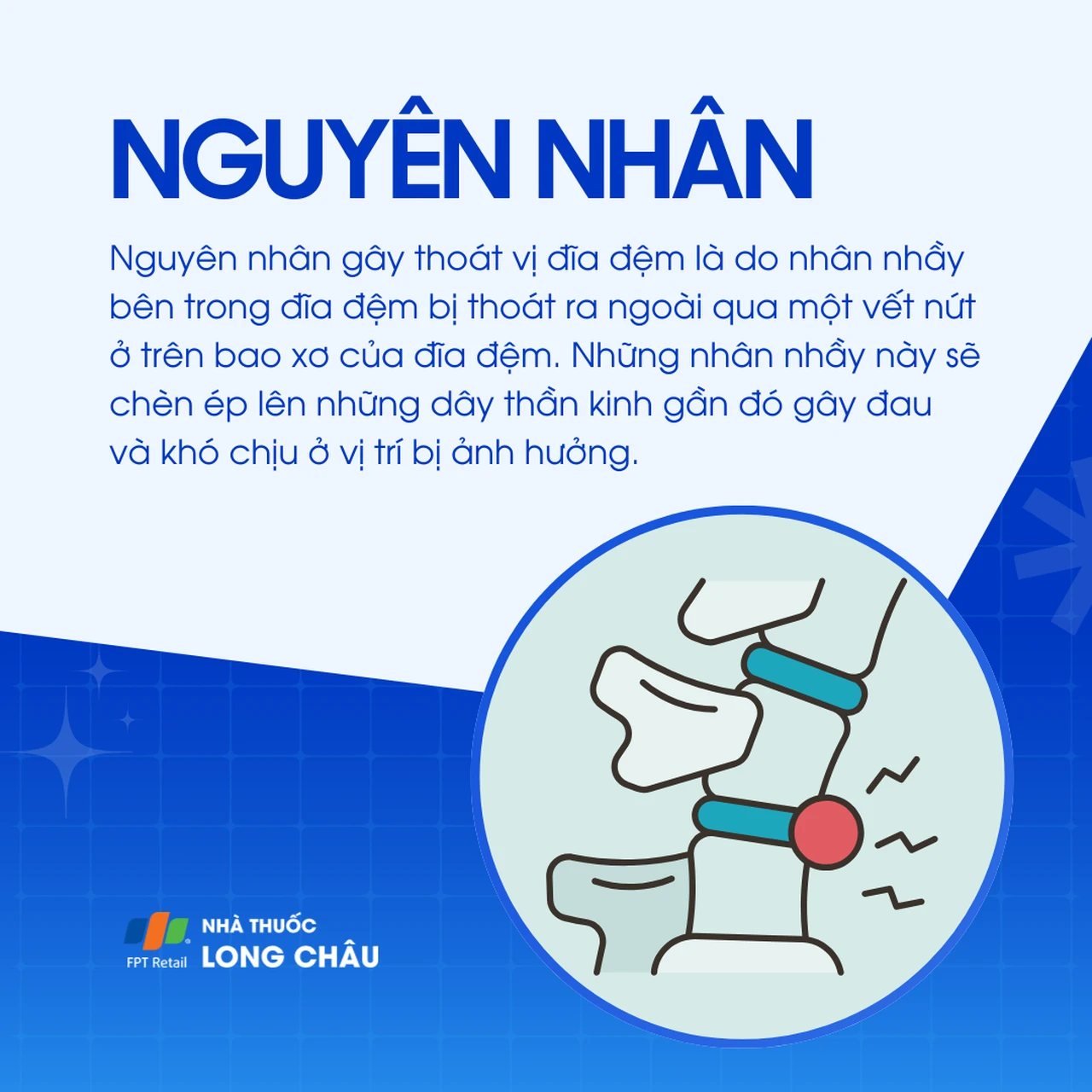 nguyên nhân thoát vị đĩa đệm do nhân nhầy thoát ra ngoài chèn ép dây thần kinh