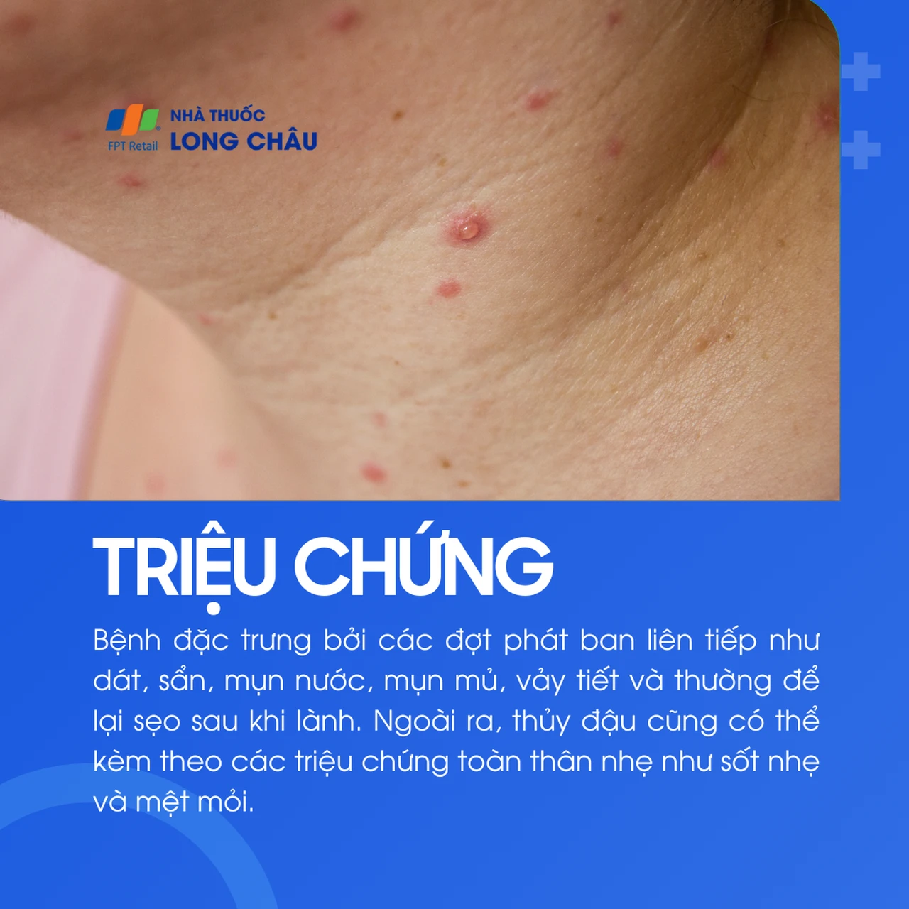 Các nốt phát ban và mụn nước điển hình của bệnh thủy đậu trên da bệnh nhân