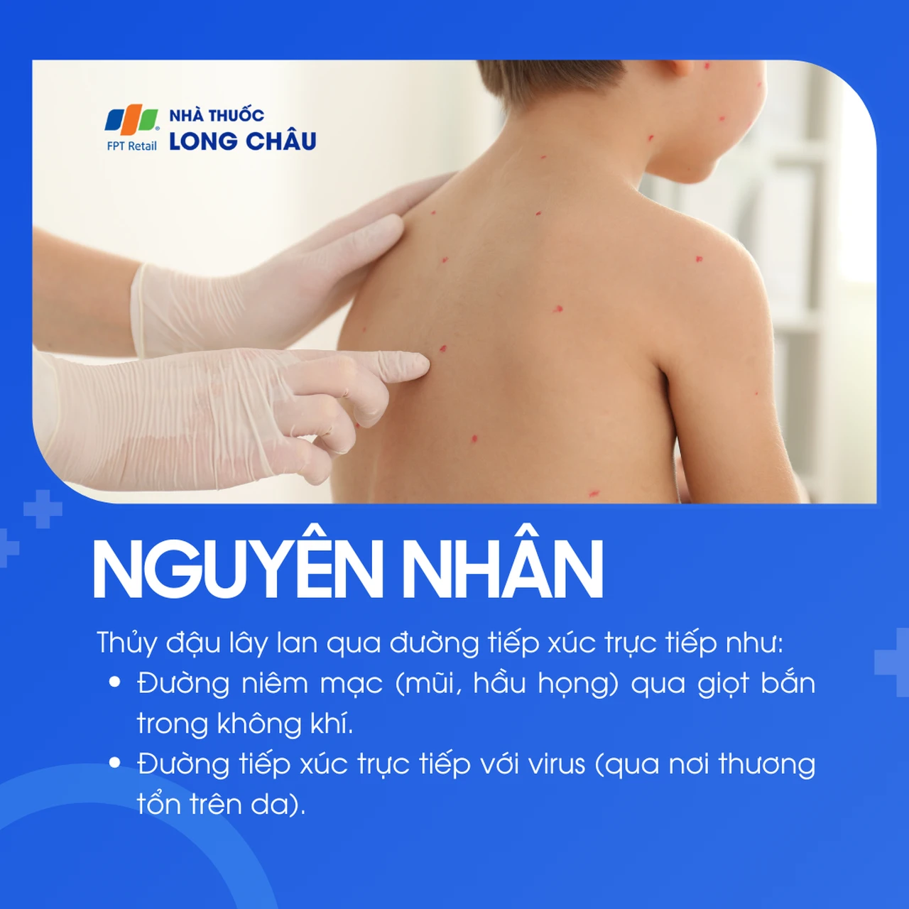 Nguyên nhân gây bệnh thủy đậu do virus Varicella-zoster lây qua đường hô hấp