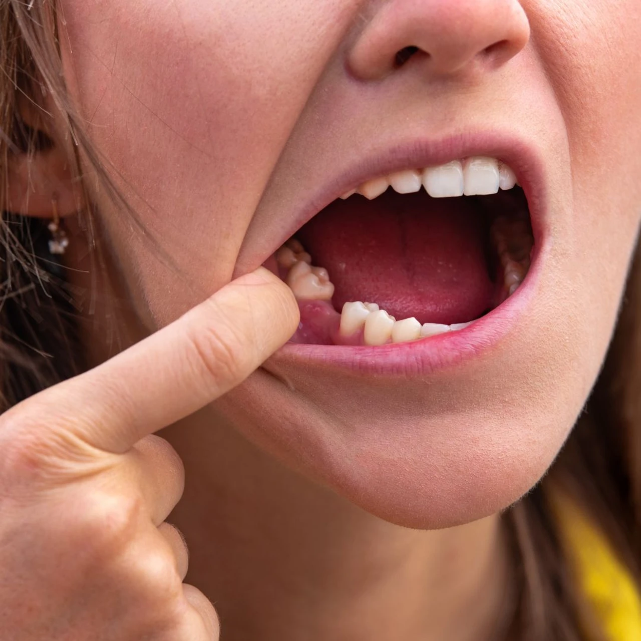 Tiêu xương hàm 2