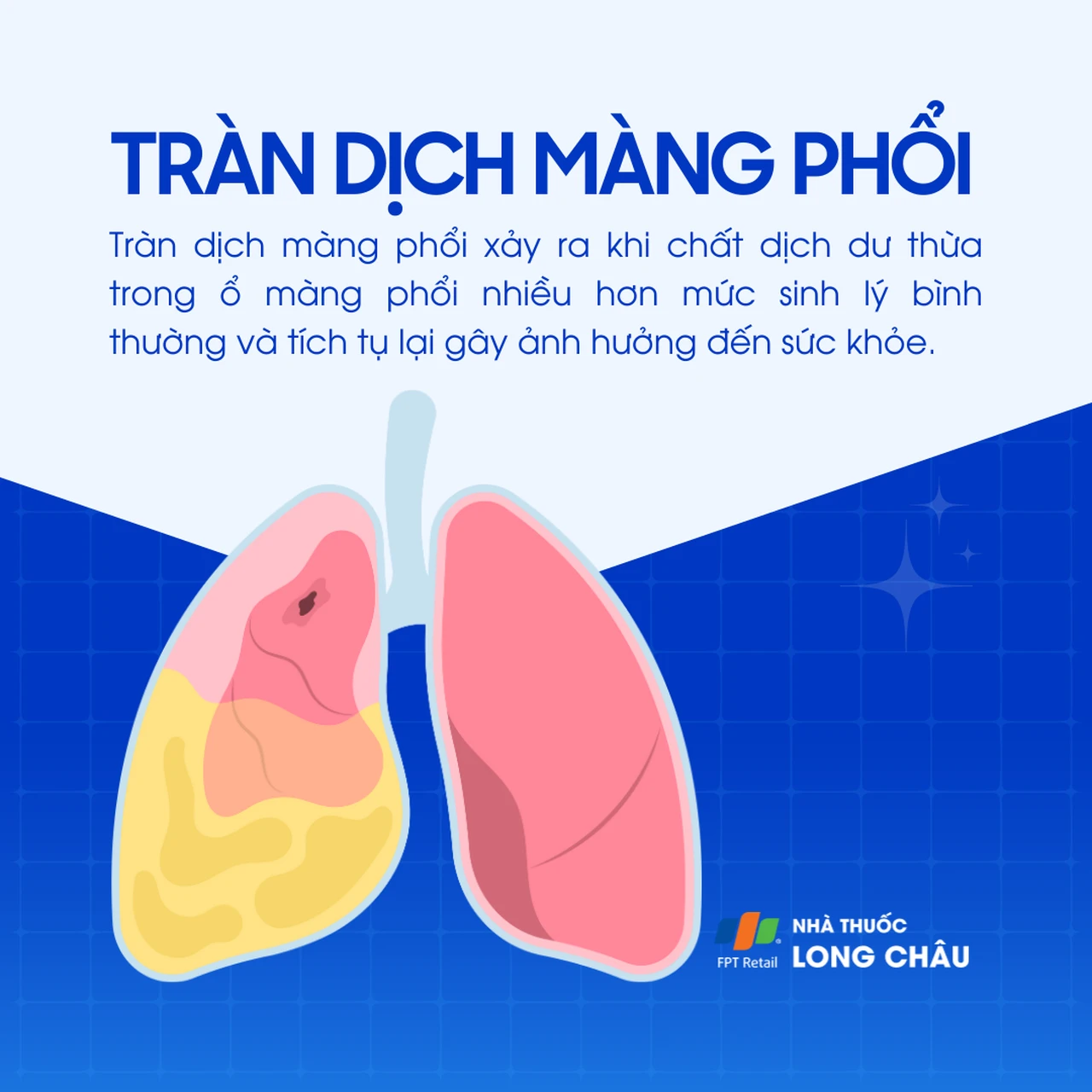 Tràn dịch màng phổi 1