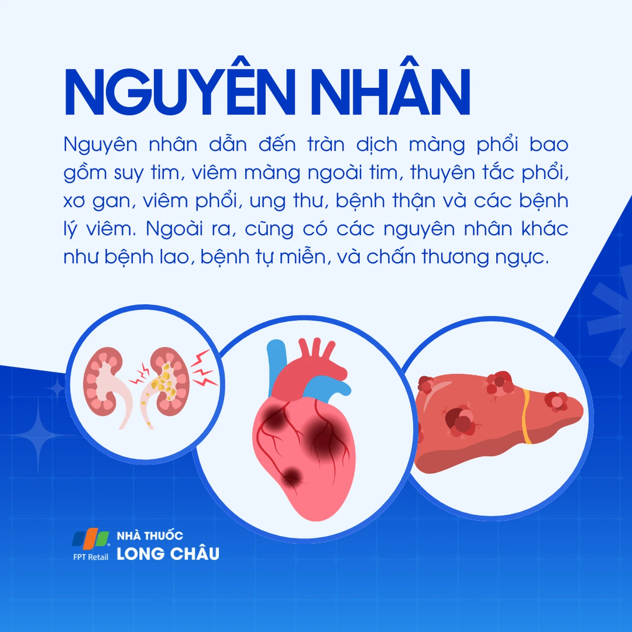 Tràn dịch màng phổi 3