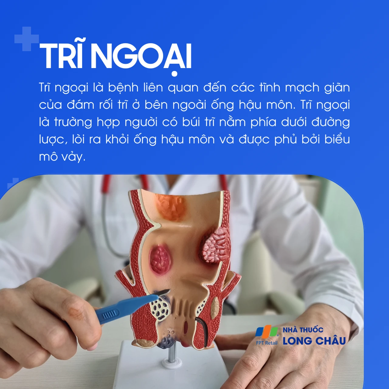 Trĩ ngoại 1