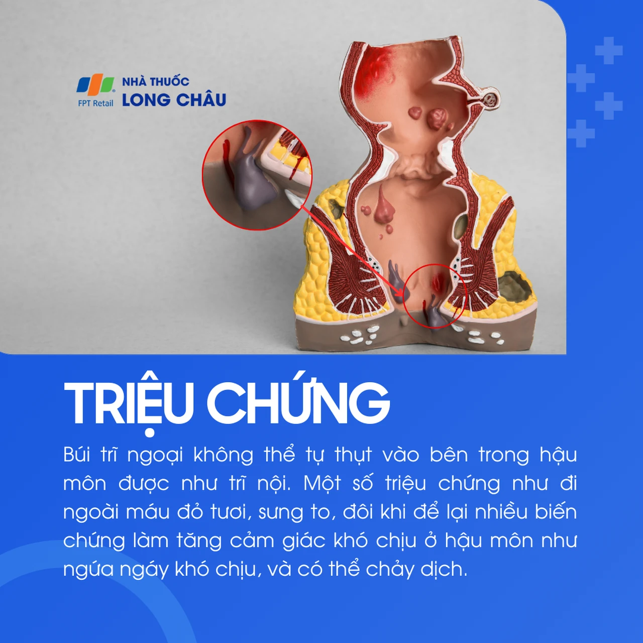 Trĩ ngoại 2