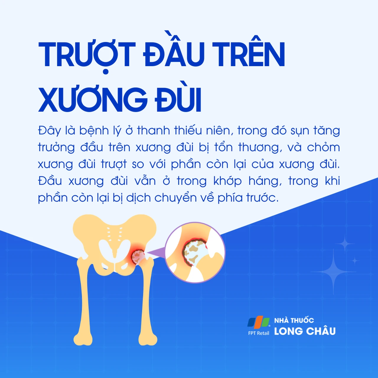 Trượt đầu trên xương đùi 1