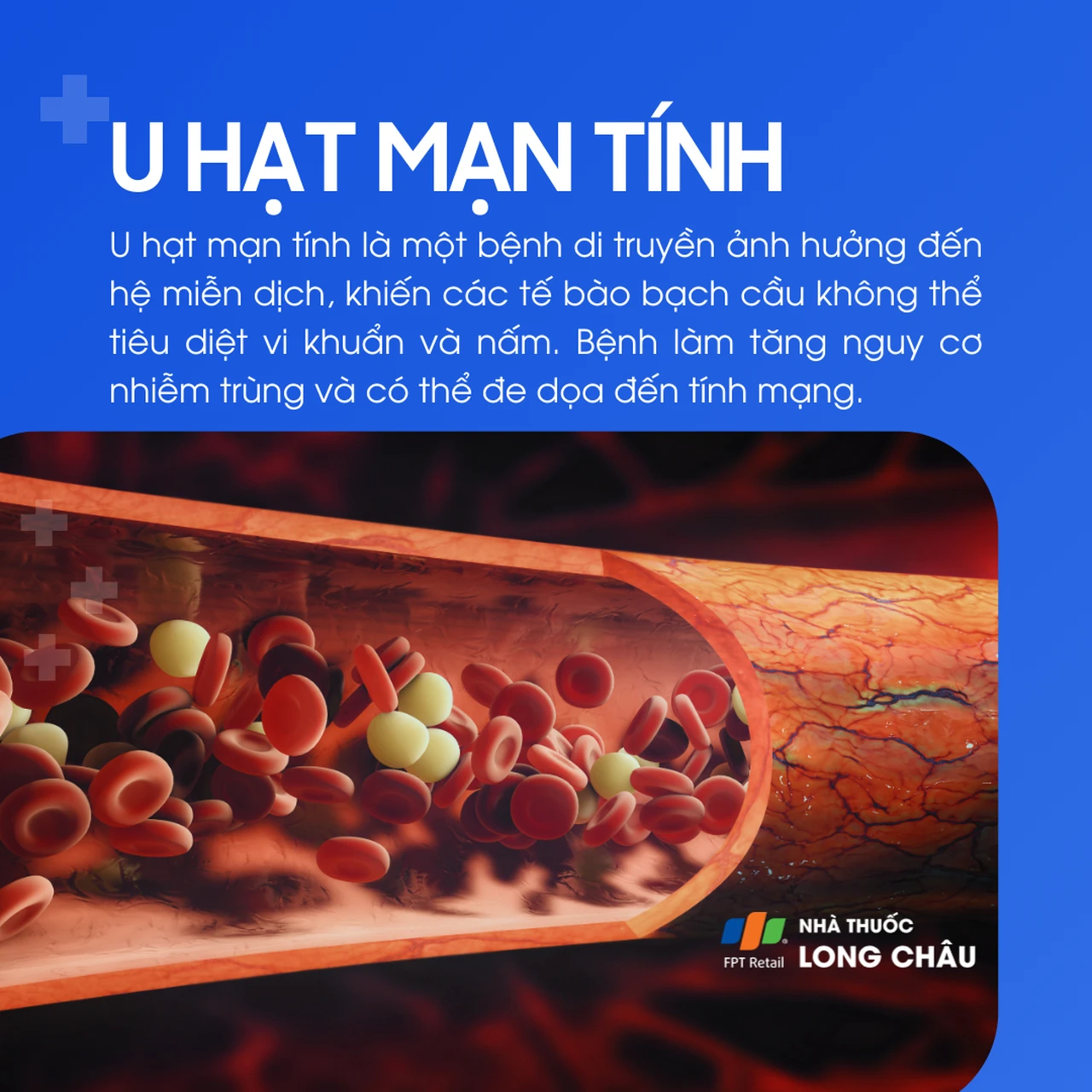 U hạt mạn tính 1