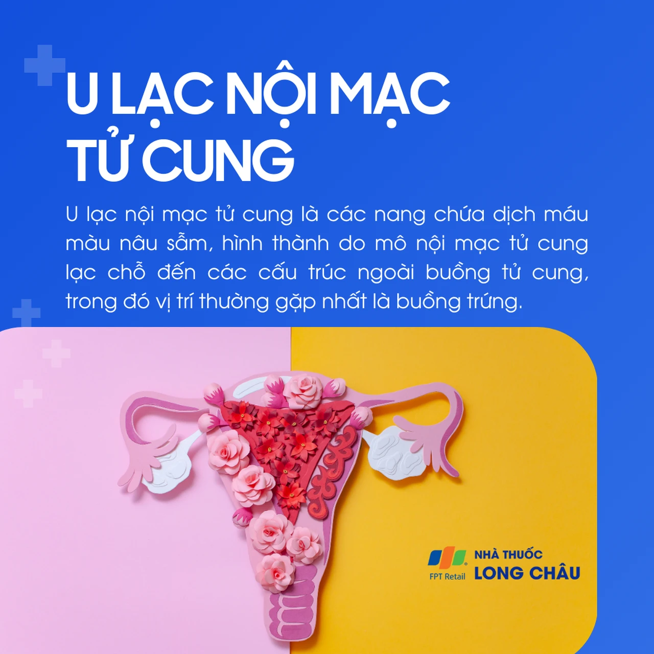 U lạc nội mạc tử cung 1