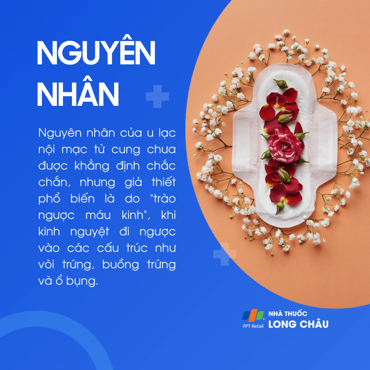 U lạc nội mạc tử cung 3
