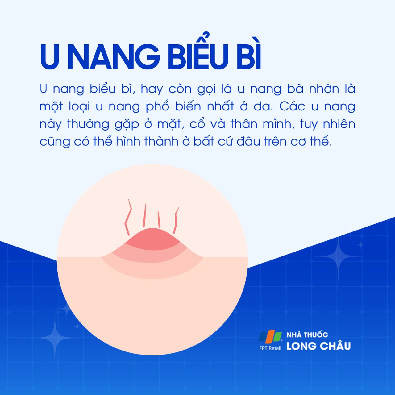 U nang biểu bì 1