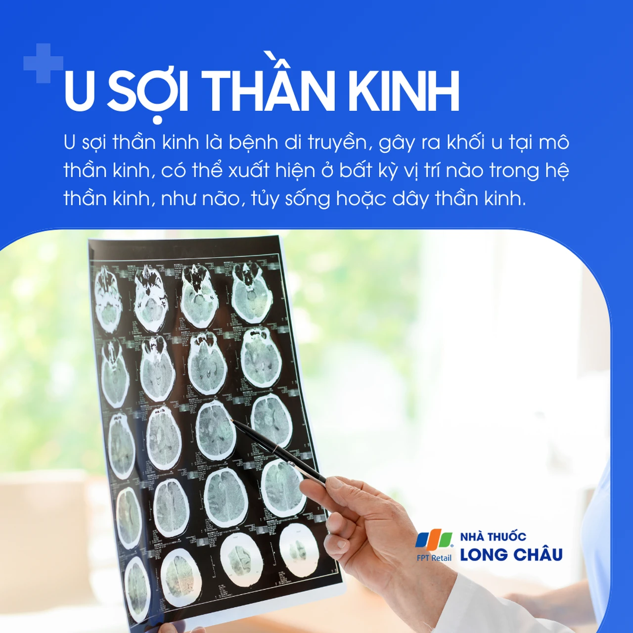 U sợi thần kinh 1