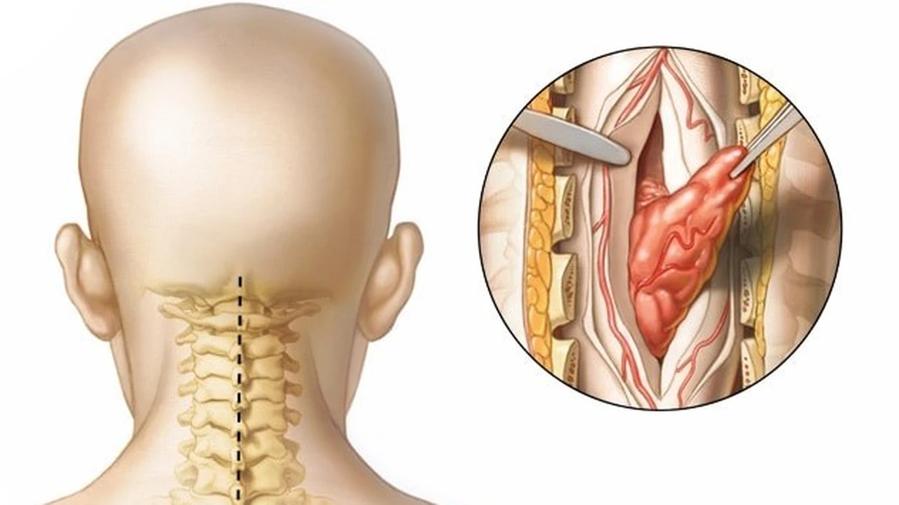 U tủy sống là gì? Nguyên nhân, triệu chứng và cách điều trị 2