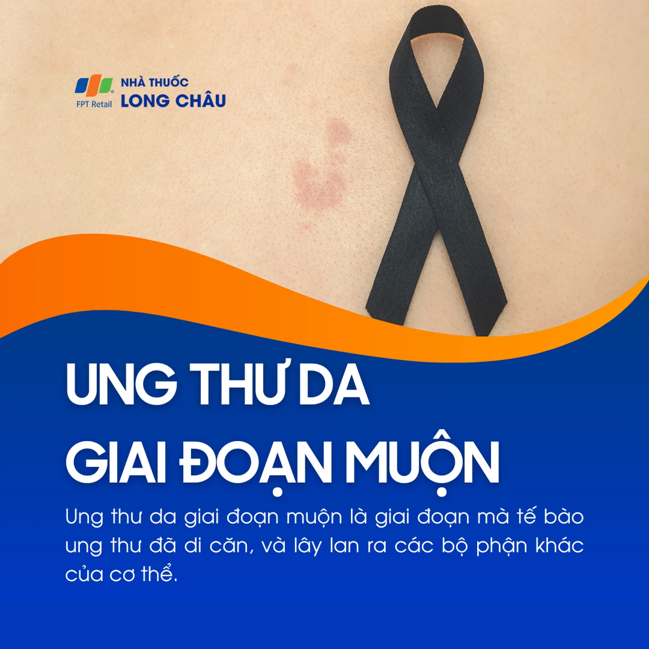 Ung thư da giai đoạn muộn 1