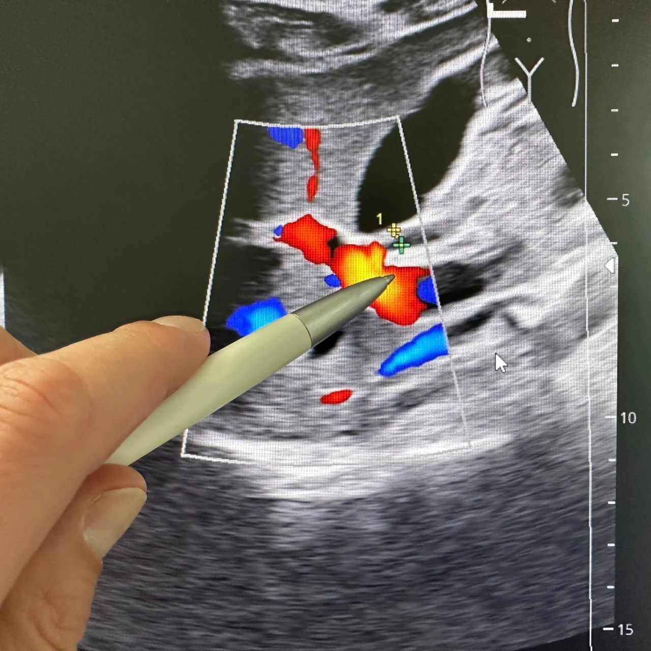  Ung thư đường mật 2