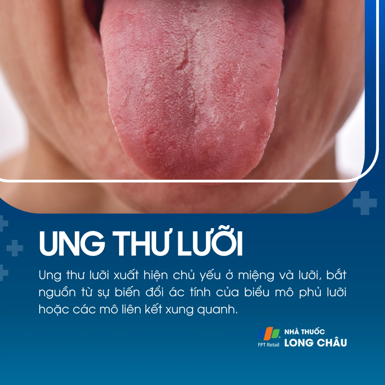Ung thư lưỡi 1