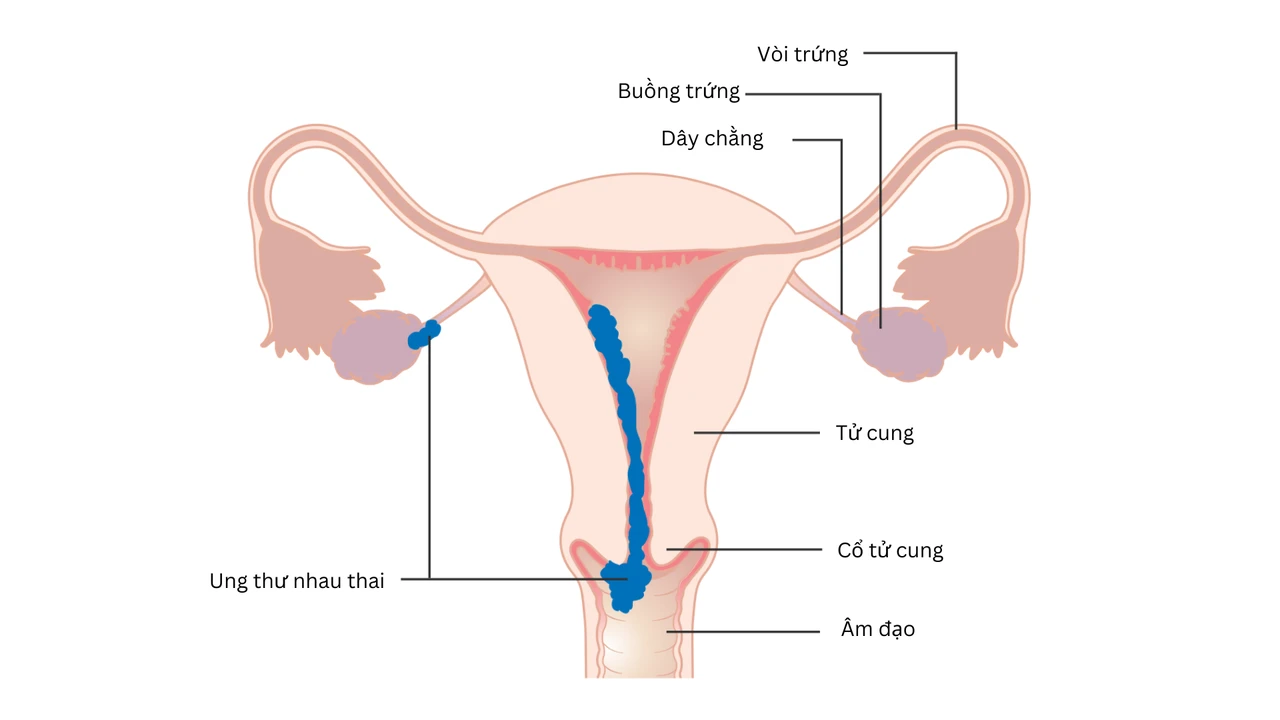 Ung thư nhau thai: Nguyên nhân, triệu chứng, chẩn đoán và điều trị 1