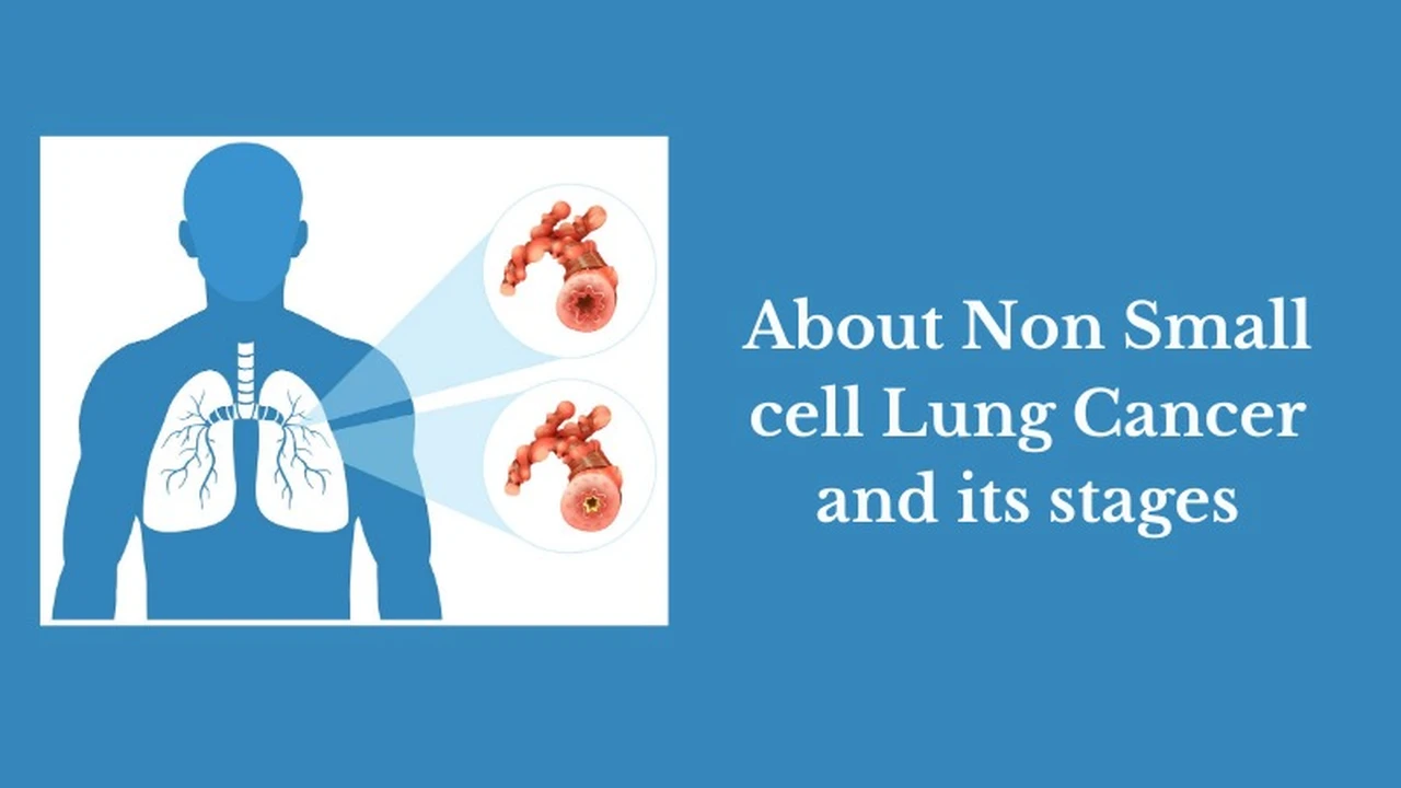 Ung thư phổi không tế bào nhỏ giai đoạn 1 là gì? Cơ hội chữa khỏi và cách phòng ngừa bệnh 1