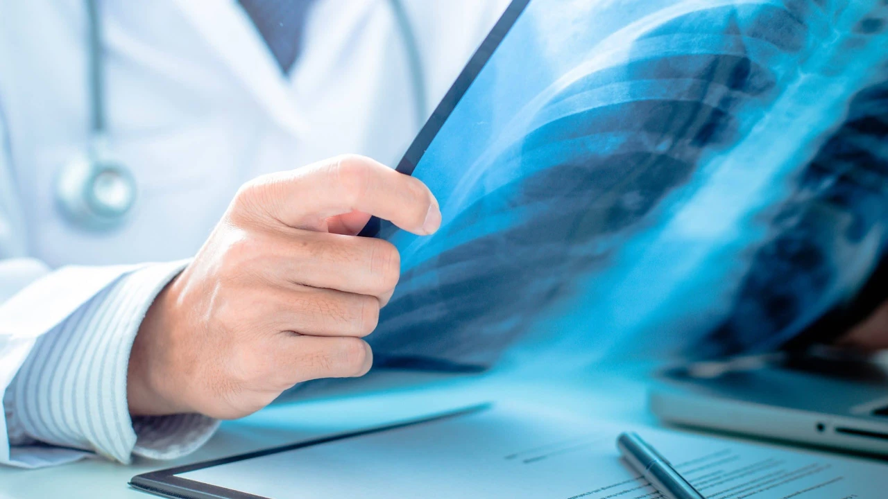 Ung thư phổi không tế bào nhỏ giai đoạn 1 là gì? Cơ hội chữa khỏi và cách phòng ngừa bệnh 3