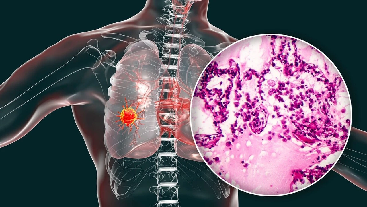Ung thư phổi không tế bào nhỏ giai đoạn II: Hiểu rõ để điều trị tốt hơn 2