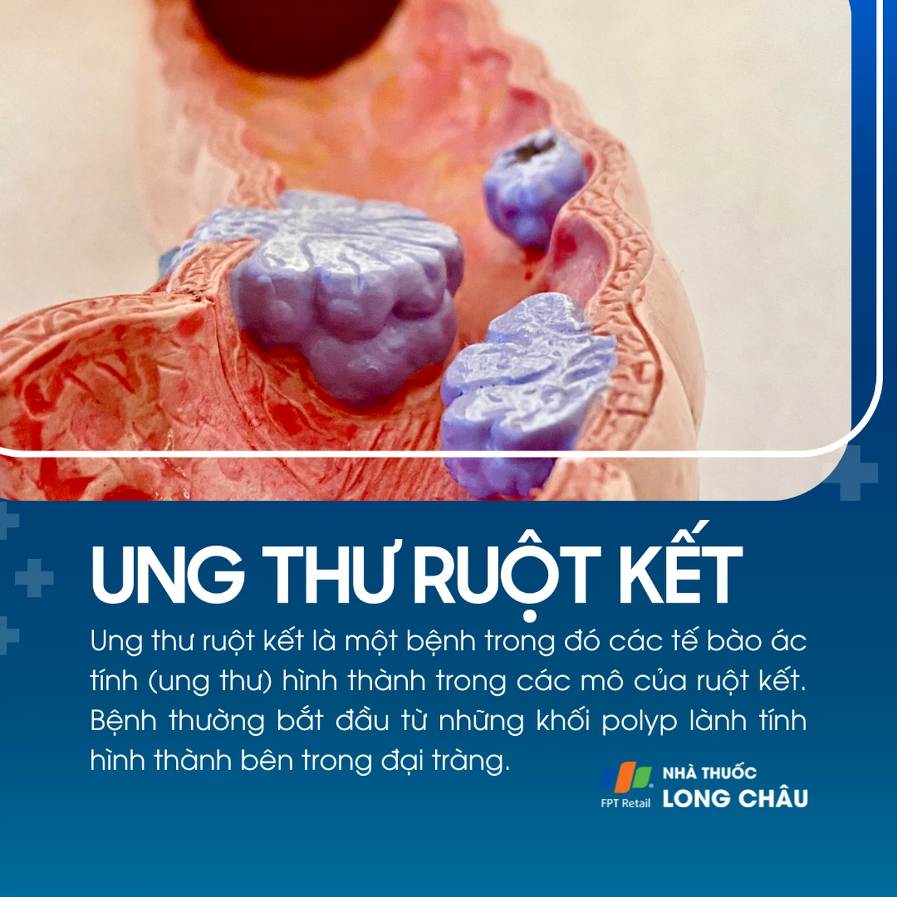 Ung thư ruột kết 1