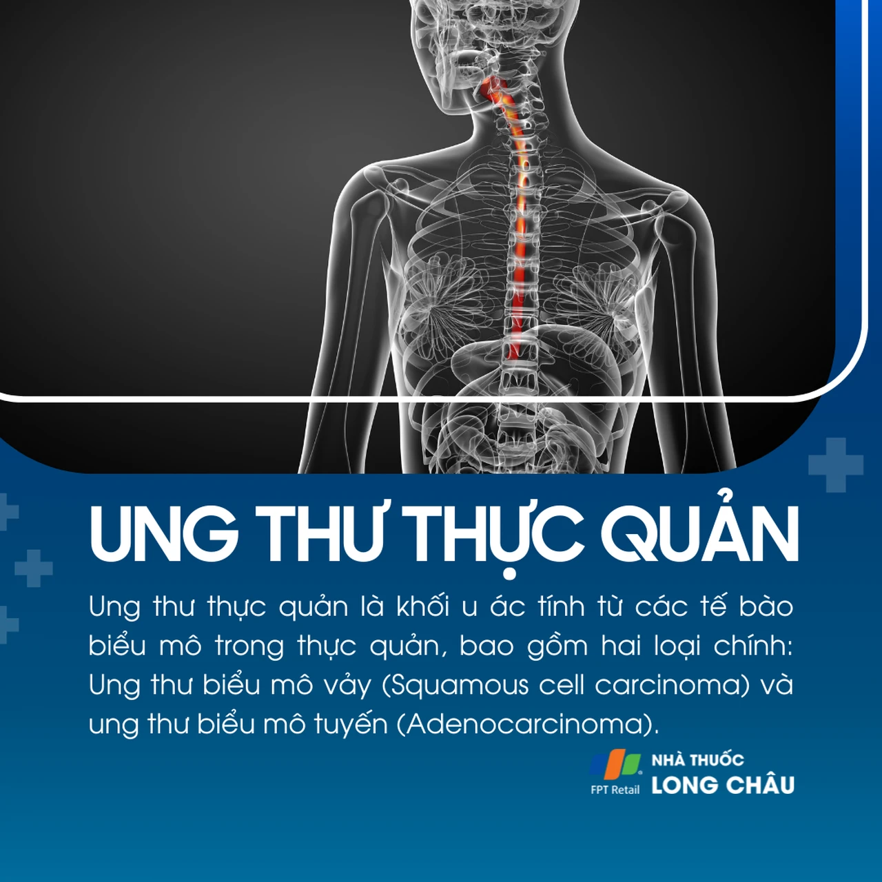 Ung thư thực quản 1