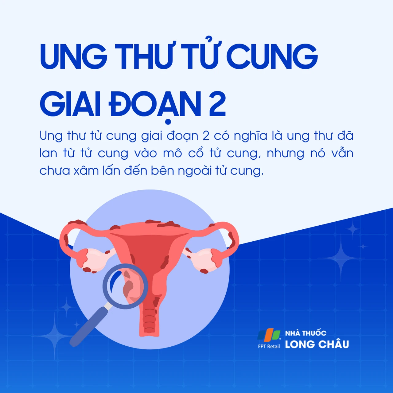 Ung thư tử cung giai đoạn 2 1