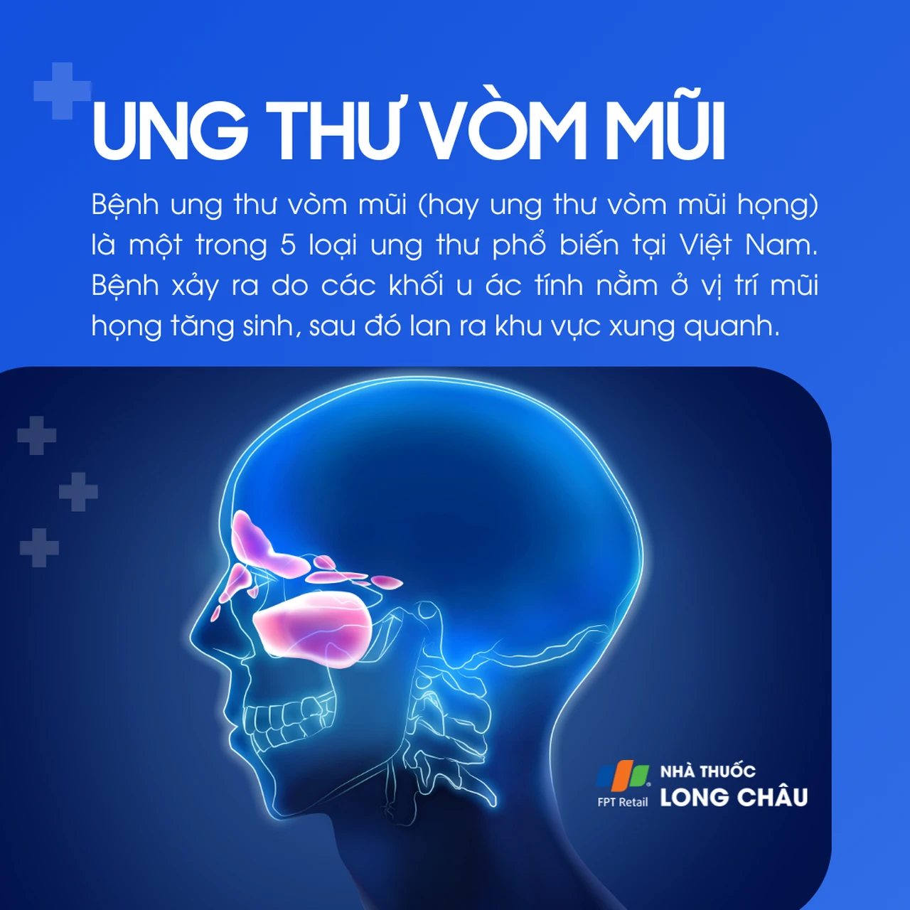 Ung thư vòm mũi 1