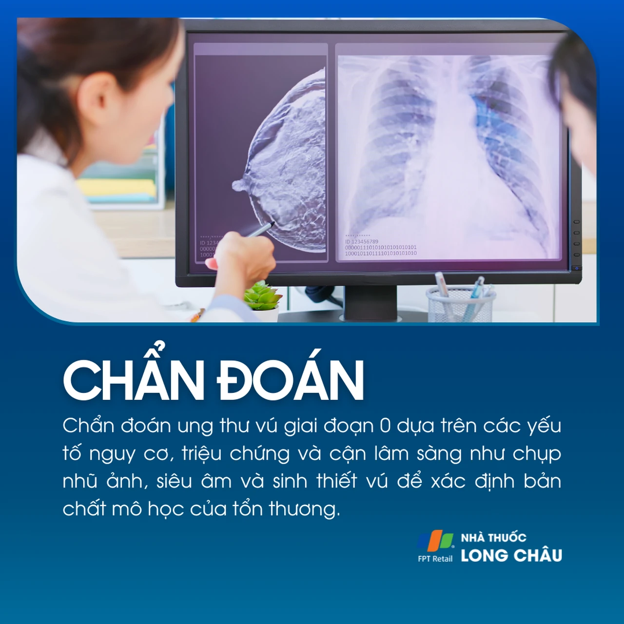 Ung thư vú giai đoạn 0 5