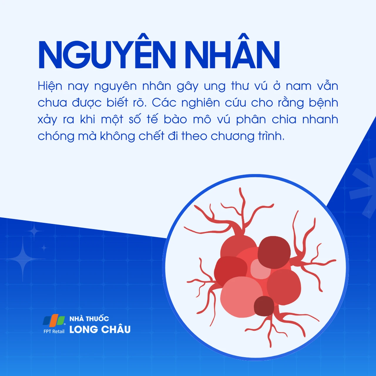 Ung thư vú ở nam 3