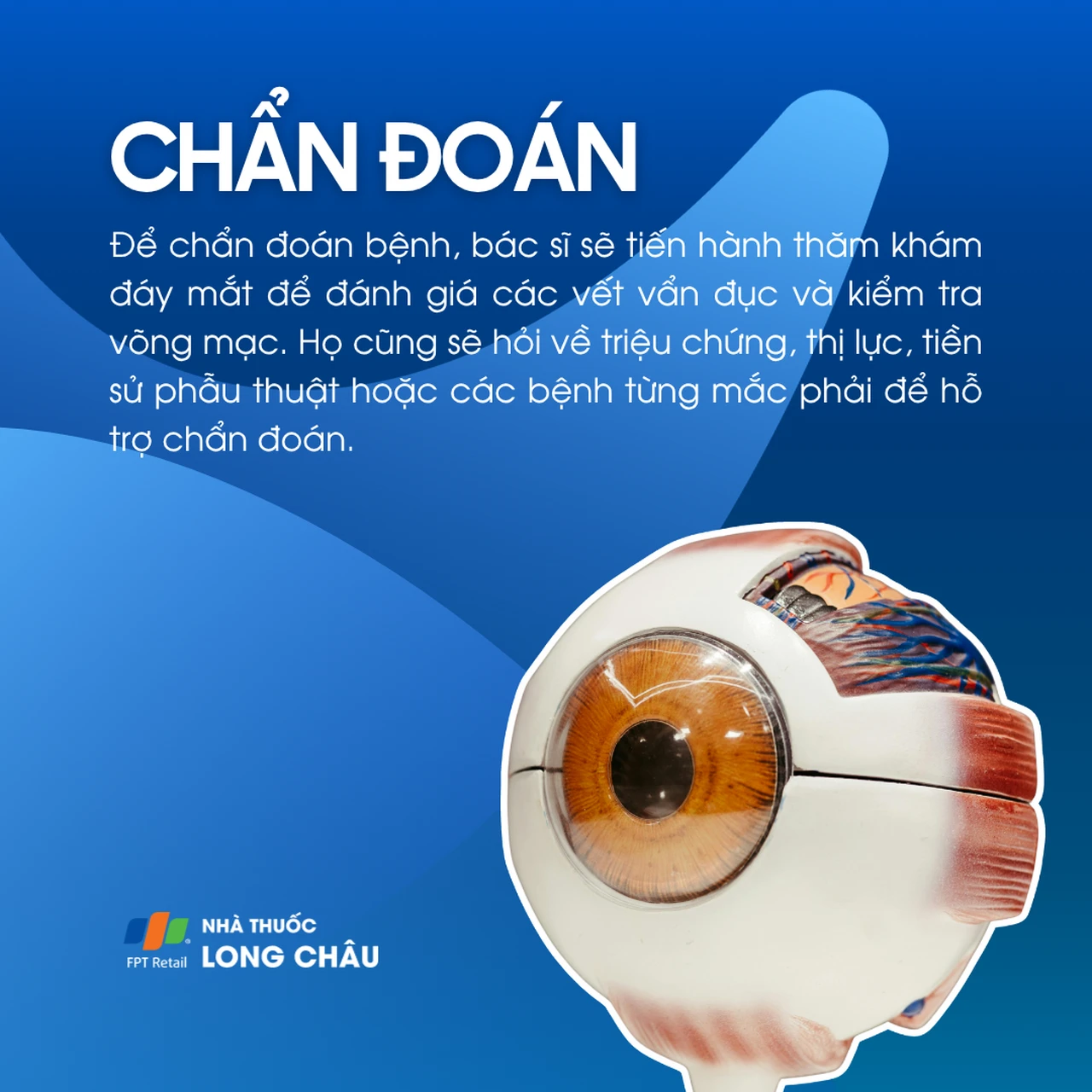 Vẩn đục dịch kính 5