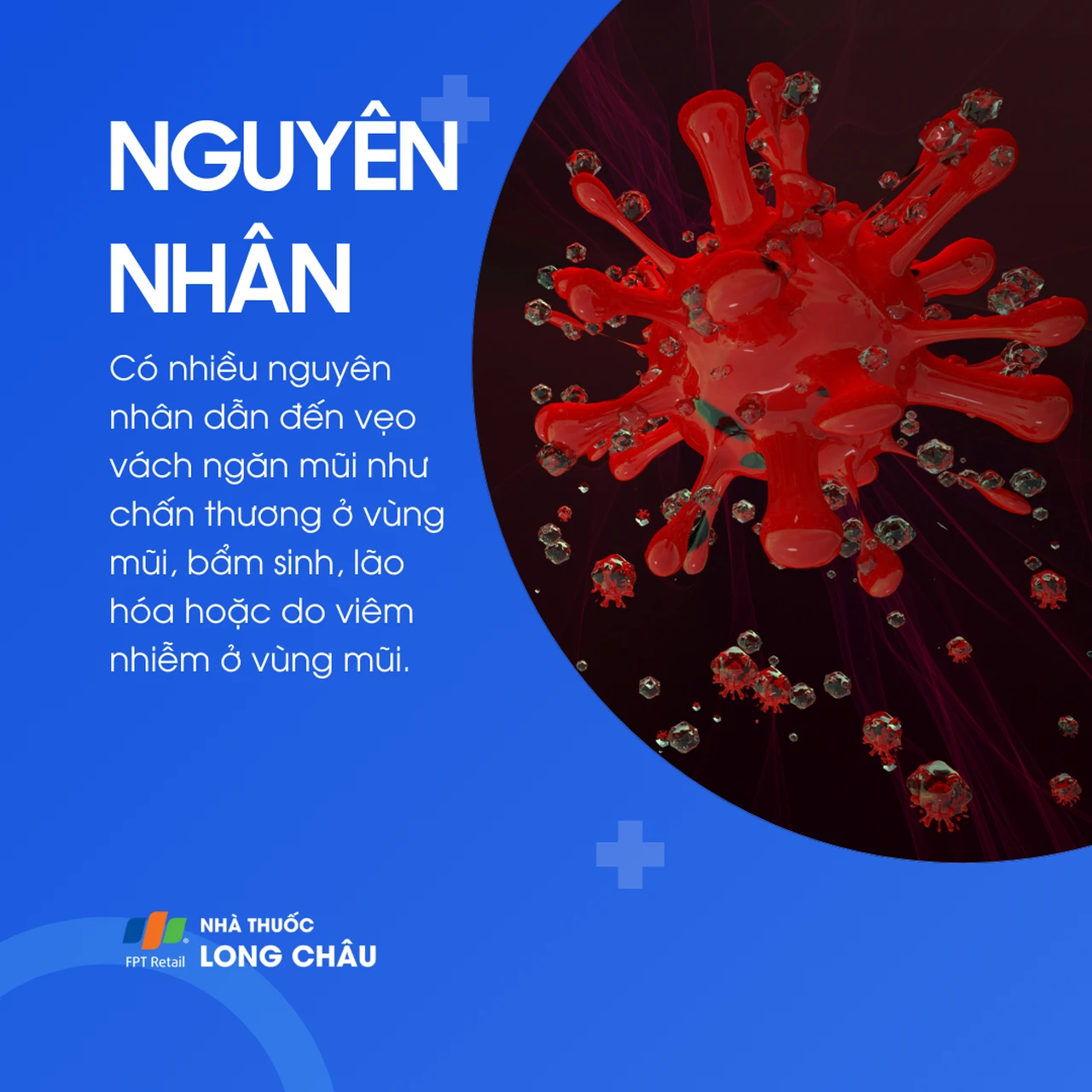 Vẹo vách ngăn mũi 3