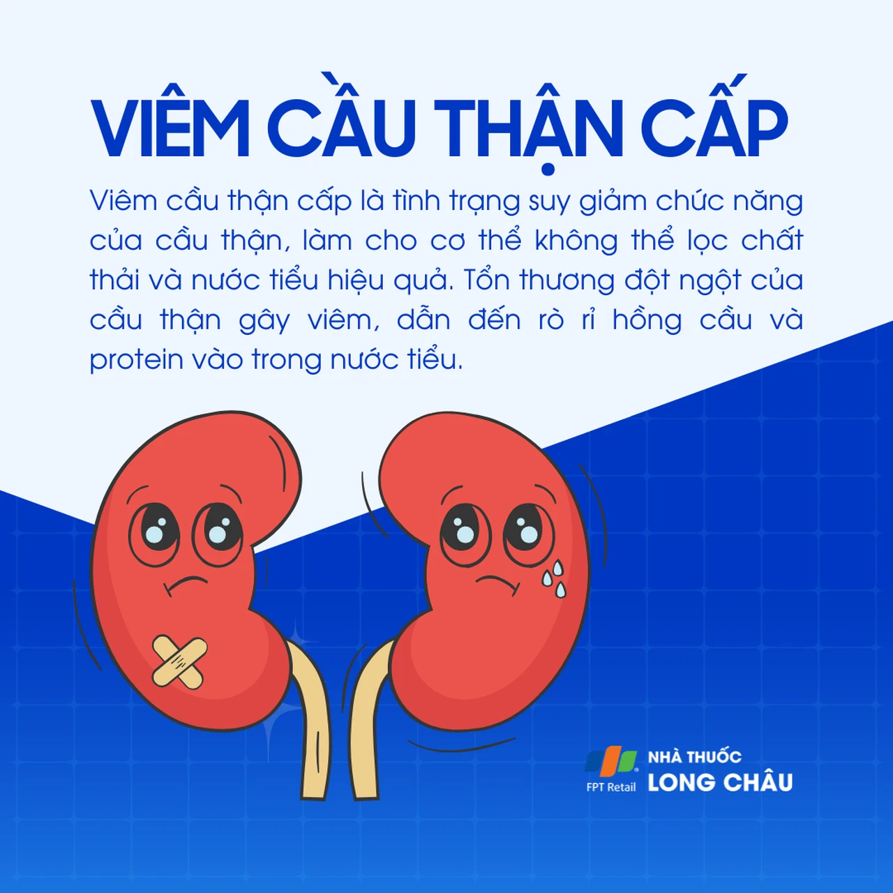 Viêm cầu thận cấp 1