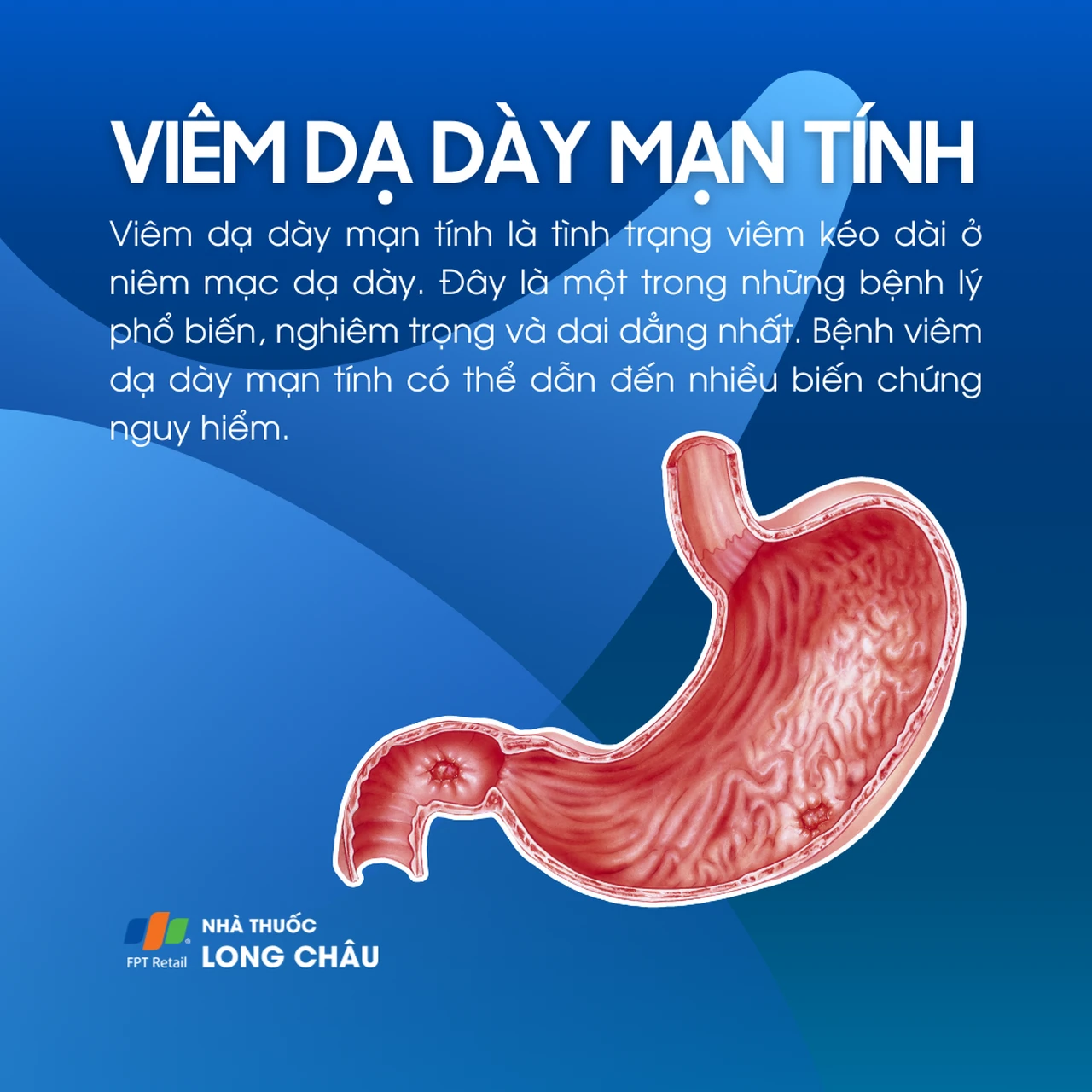 Viêm dạ dày mạn tính 1