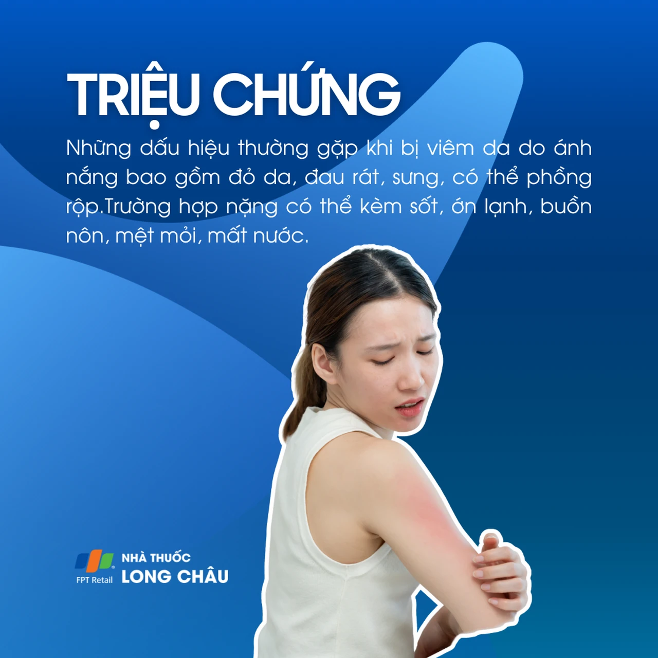 Viêm da do ánh nắng 2