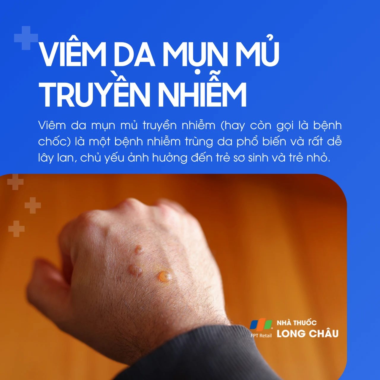 Viêm da mụn mủ truyền nhiễm 1