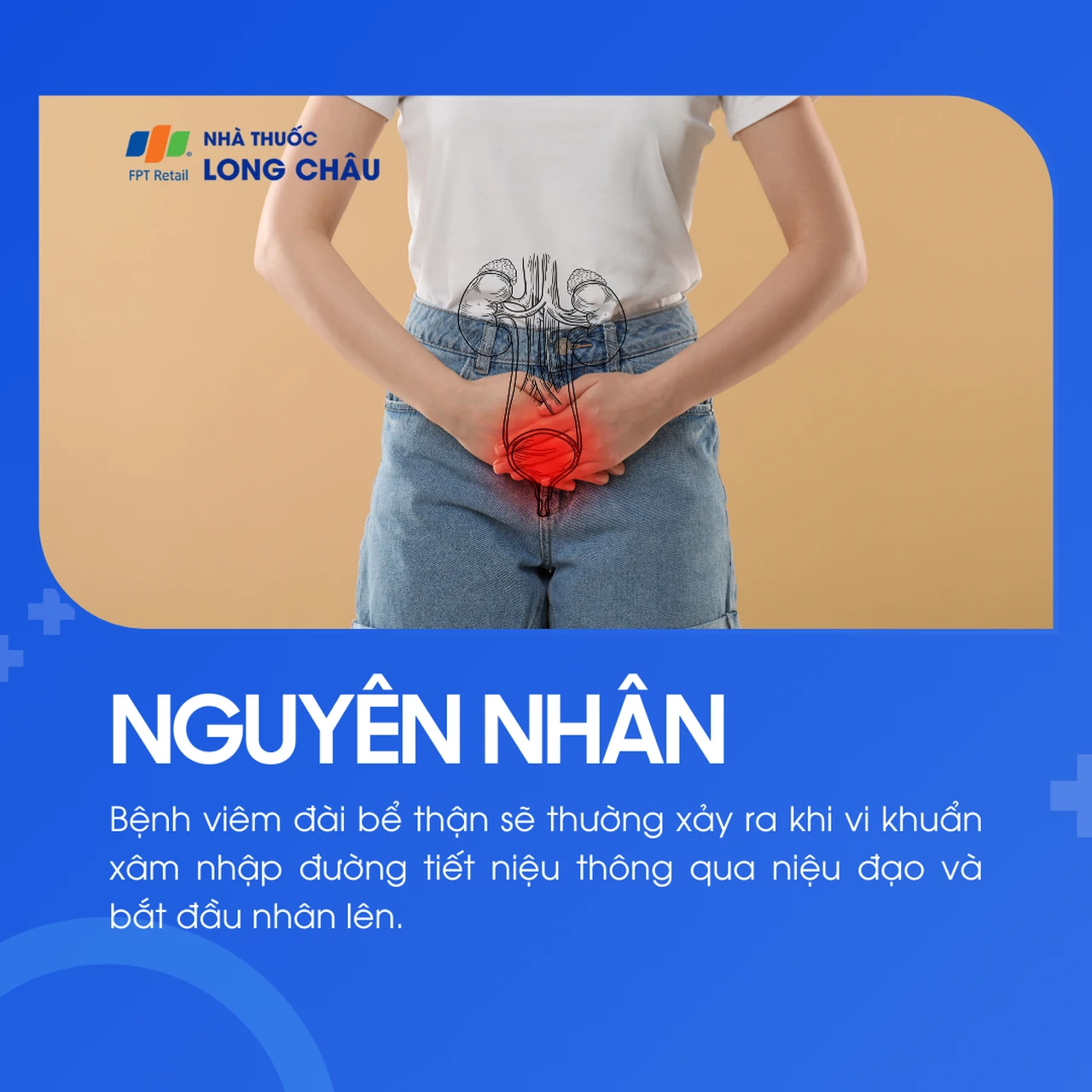 Viêm đài bể thận 3