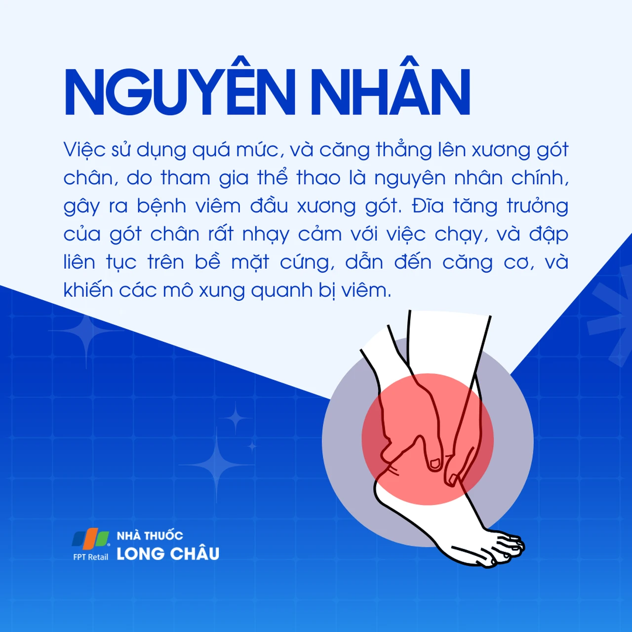 Viêm đầu xương gót 3
