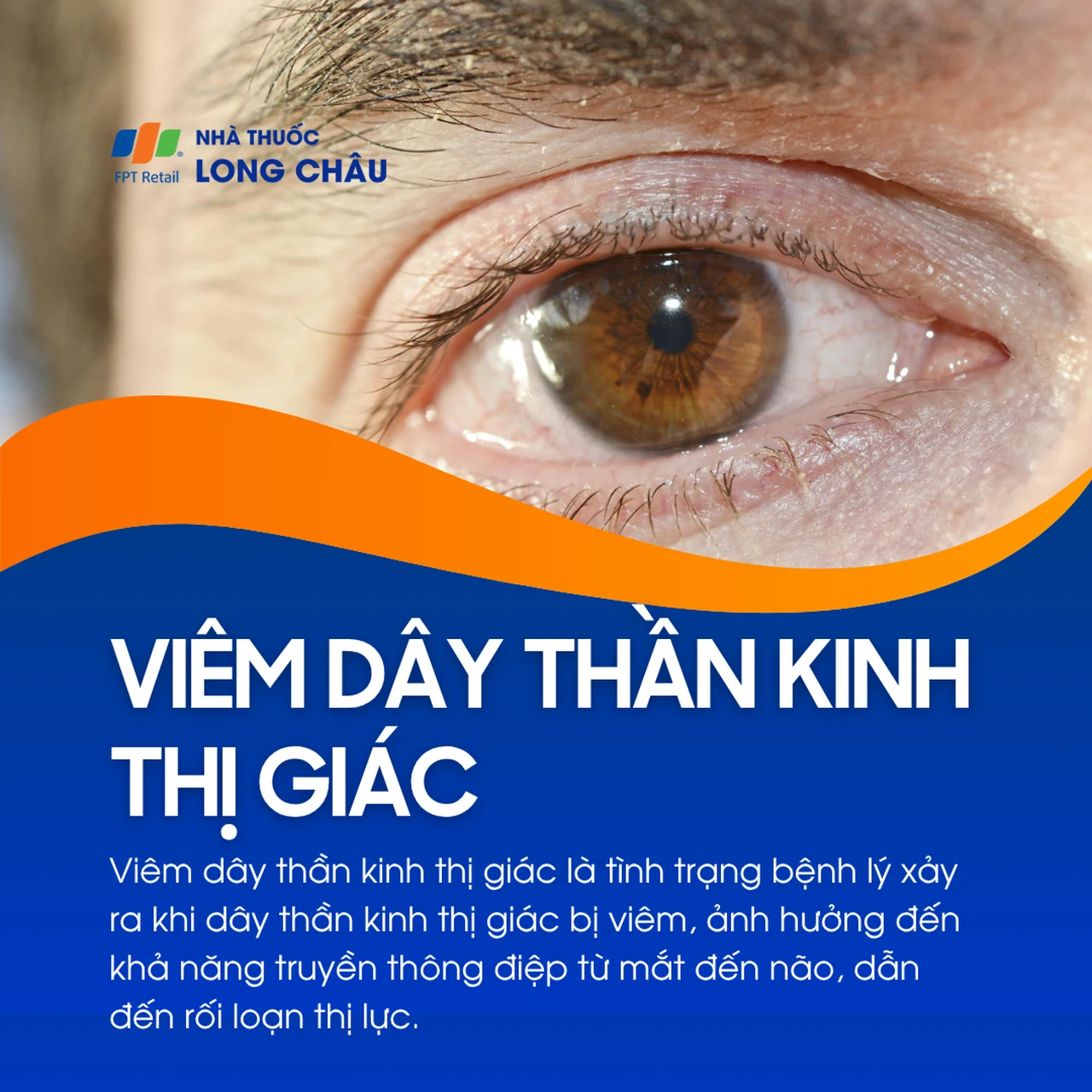 Viêm dây thần kinh thị giác 1