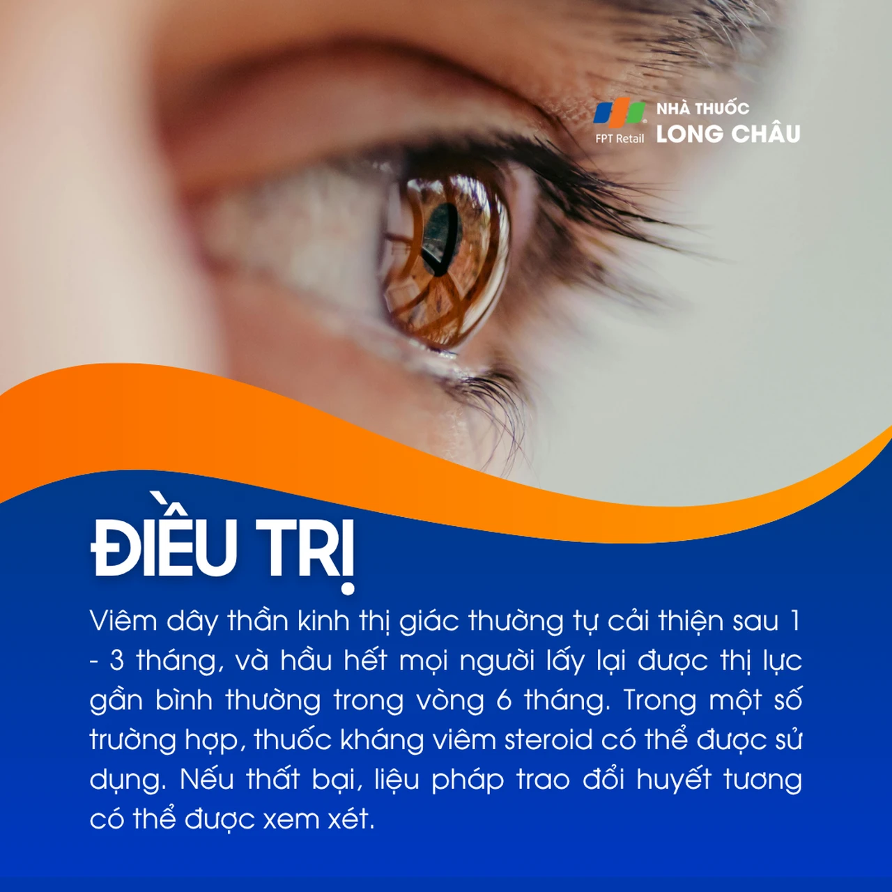 Viêm dây thần kinh thị giác 6