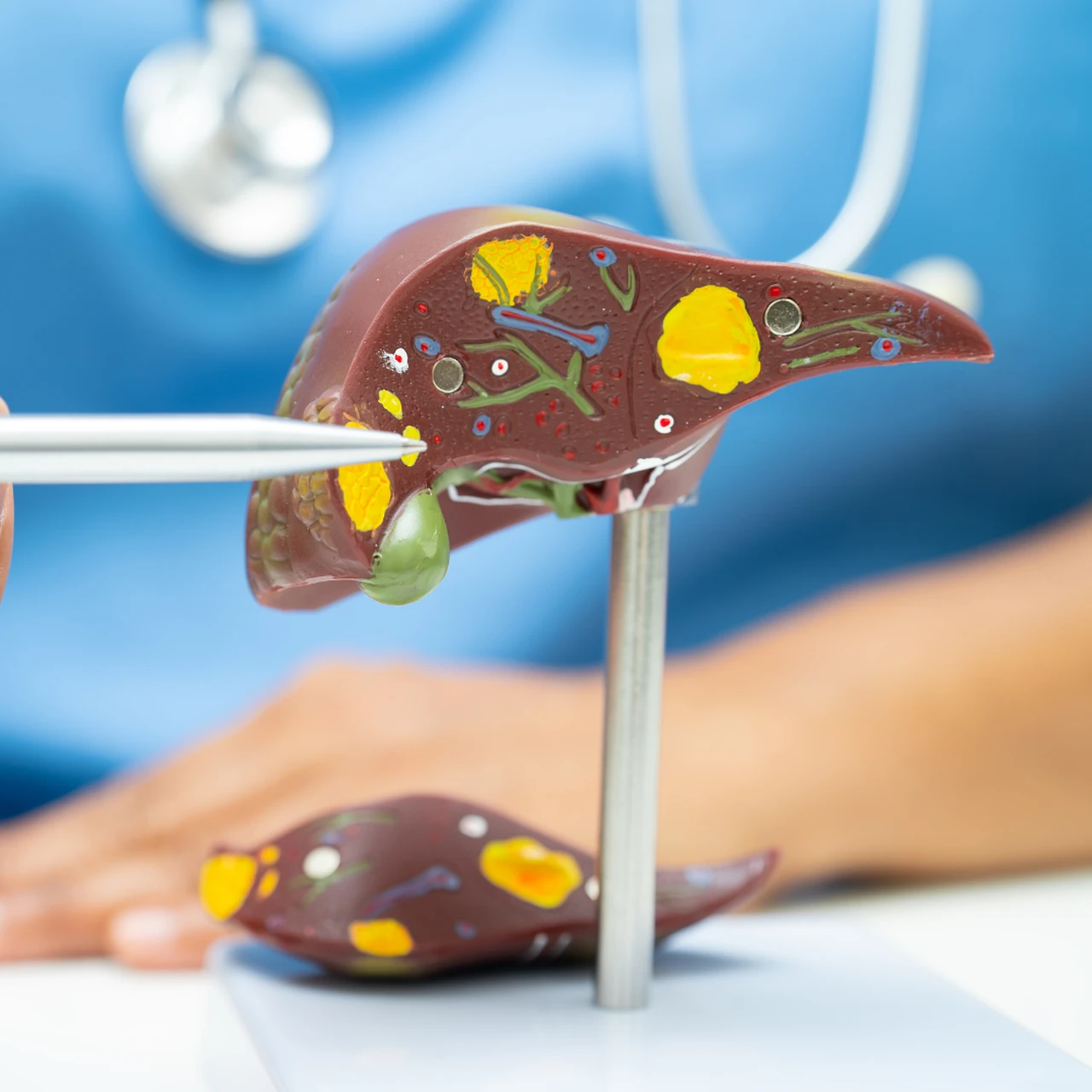 Viêm gan G là gì? Nguyên nhân, triệu chứng và cách điều trị 3